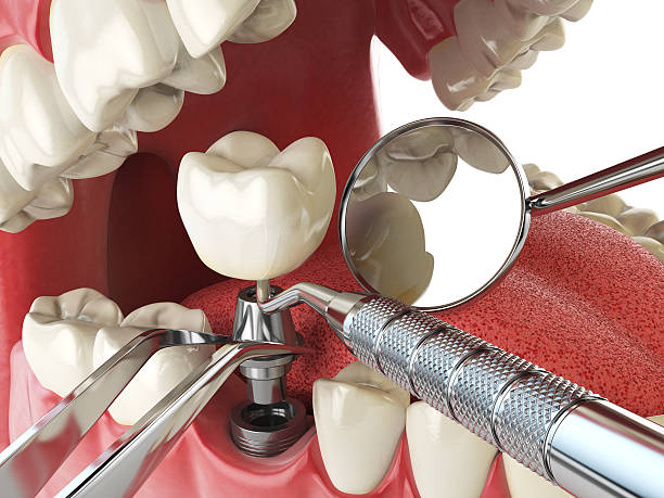 Best Emergency Treatment for Dental Infections or Abscesses in USA